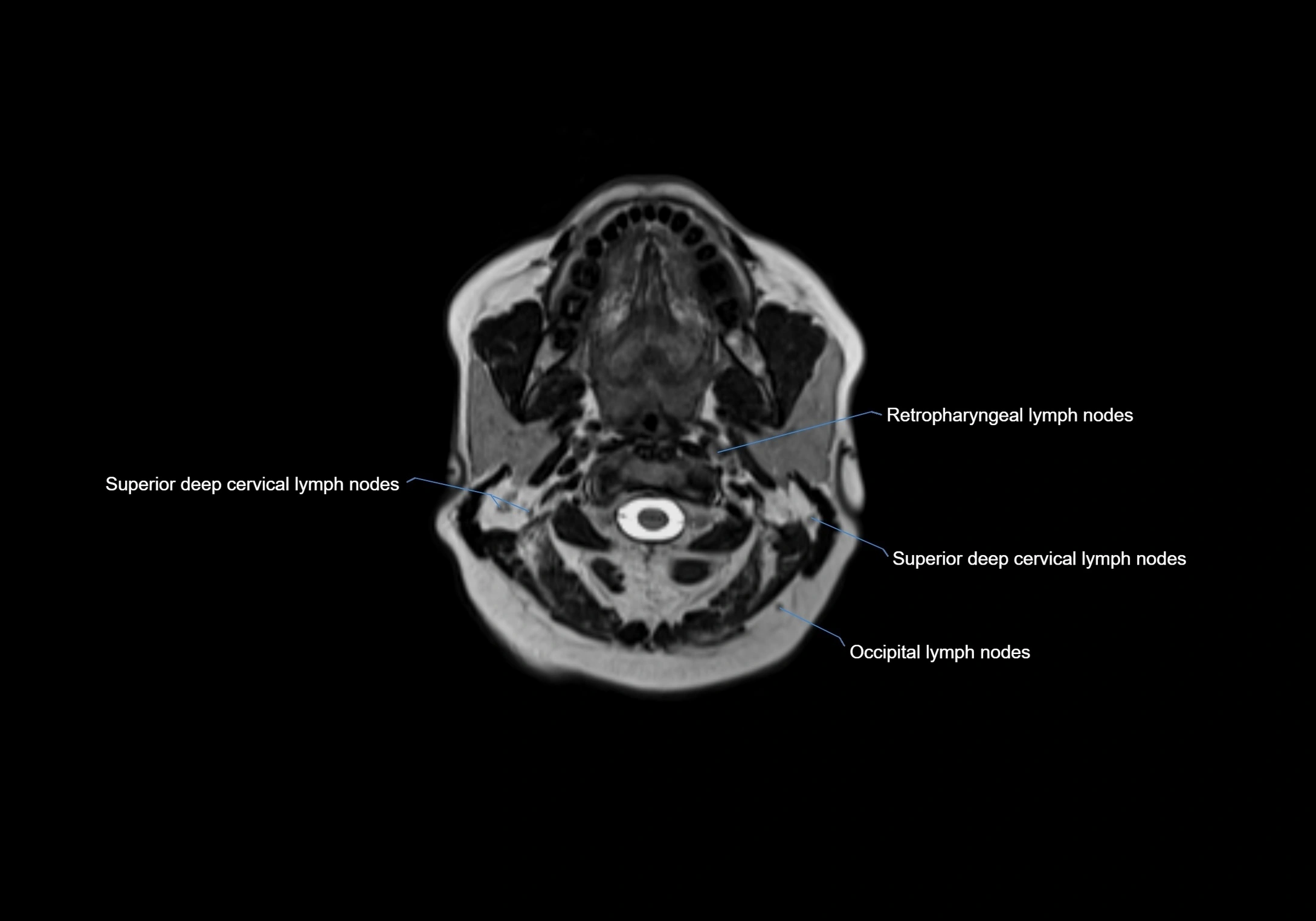 Neck axial  lymph node cross sectional MRI anatomy 3T MRI  image-img-00001-00037.webp